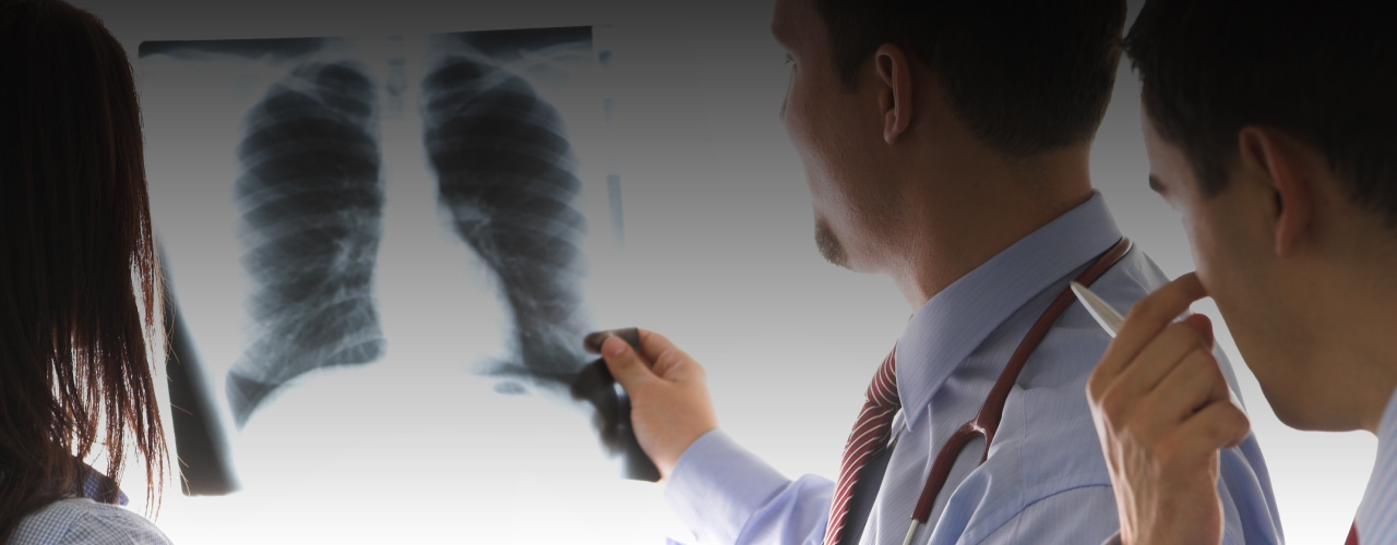 cancro do pulmão - cancro online