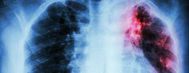 cancro do pulmão - cancro online