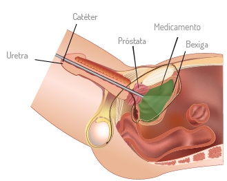 Cancro de Bexiga - Tratamento intravesical