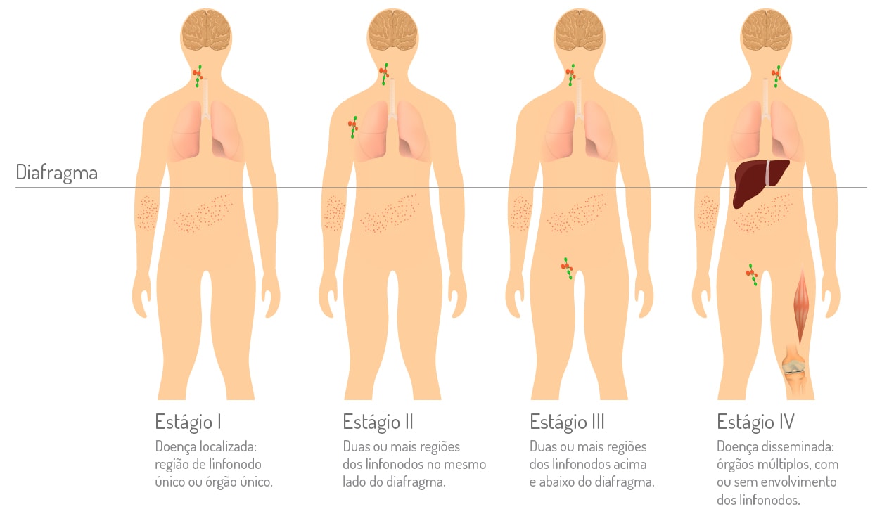 Linfoma de Hodgkin - Tratamento - Estágio