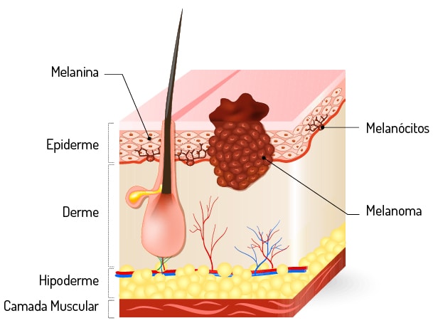 Melanoma - O que é o melanoma?