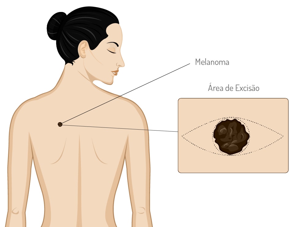 Melanoma - Informação básica - Tratamento de Melanoma