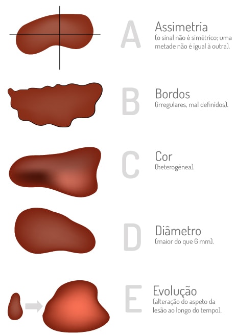 Imagem melanoma