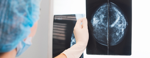Diagnostico Cancro da Mama - Cancro Online