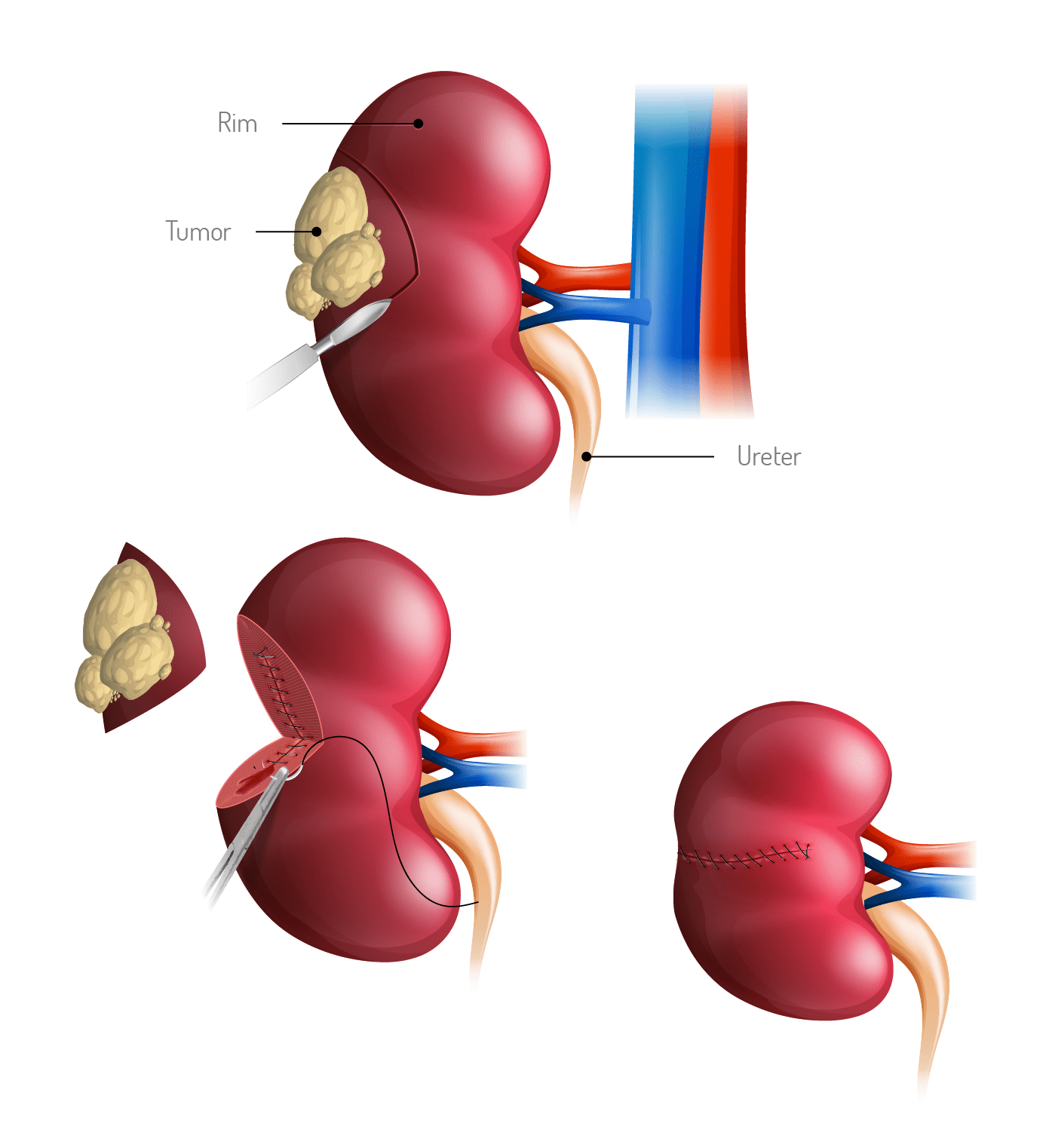 Cirurgia para Cancro do Rim