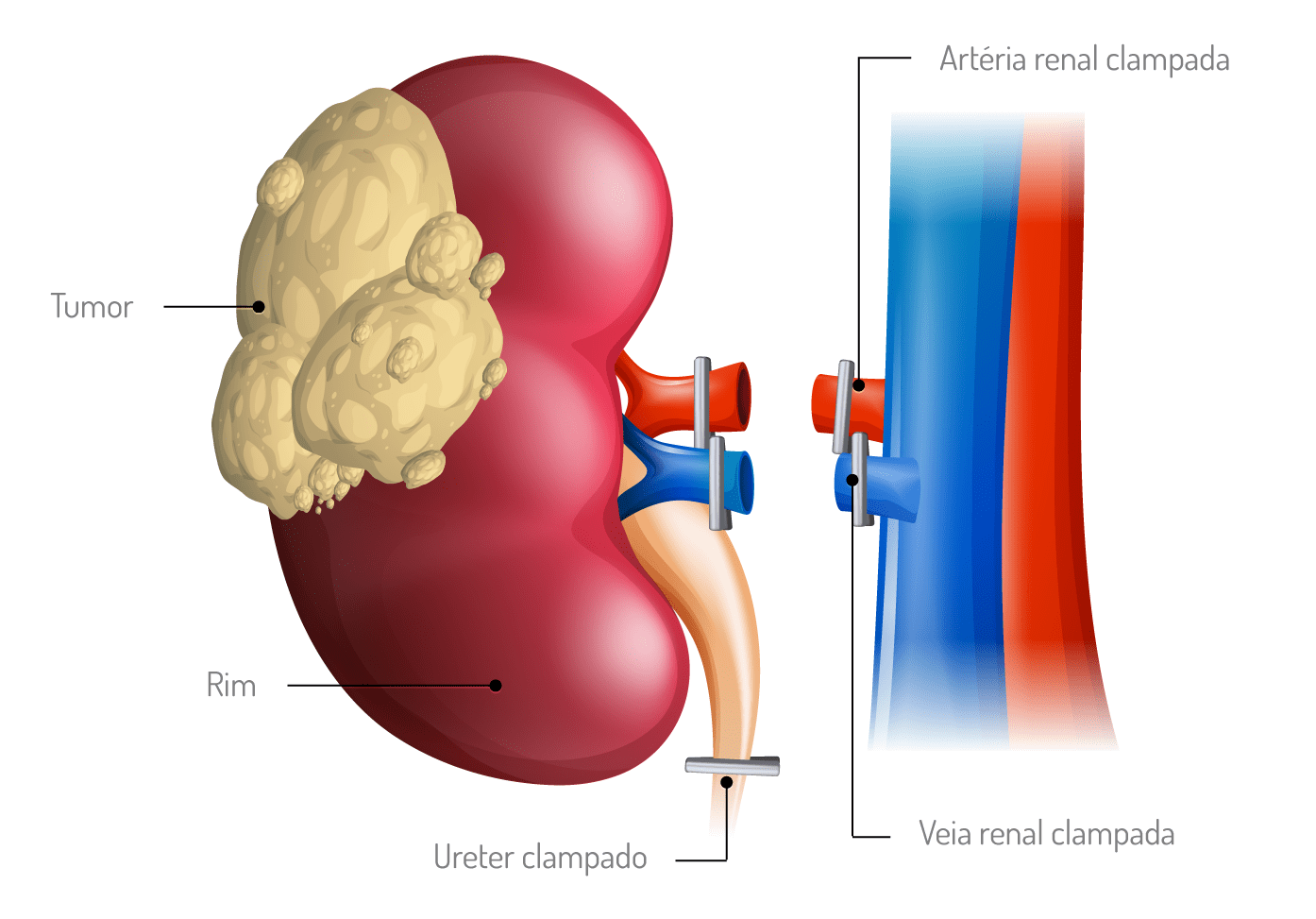 Cirurgia Radical para Cancro do Rim