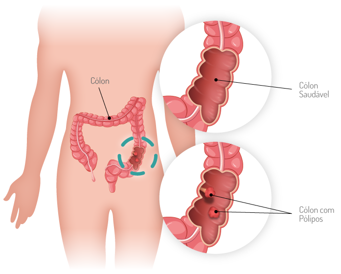 Cancro Colorretal