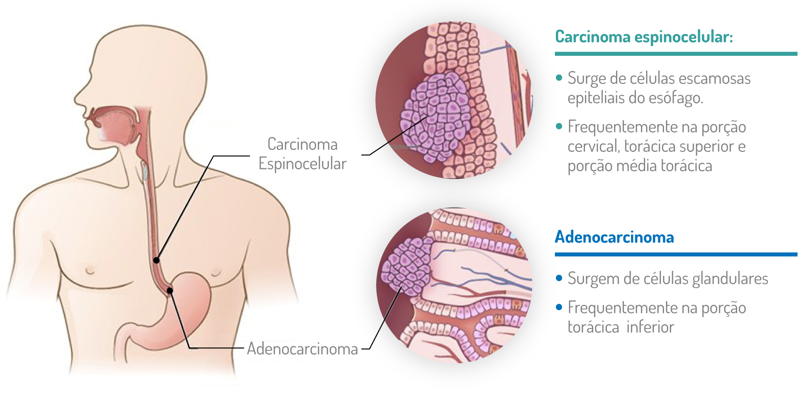 Estadiamento do Cancro do Esófago