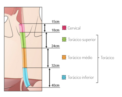 Localização do tumor no esófago